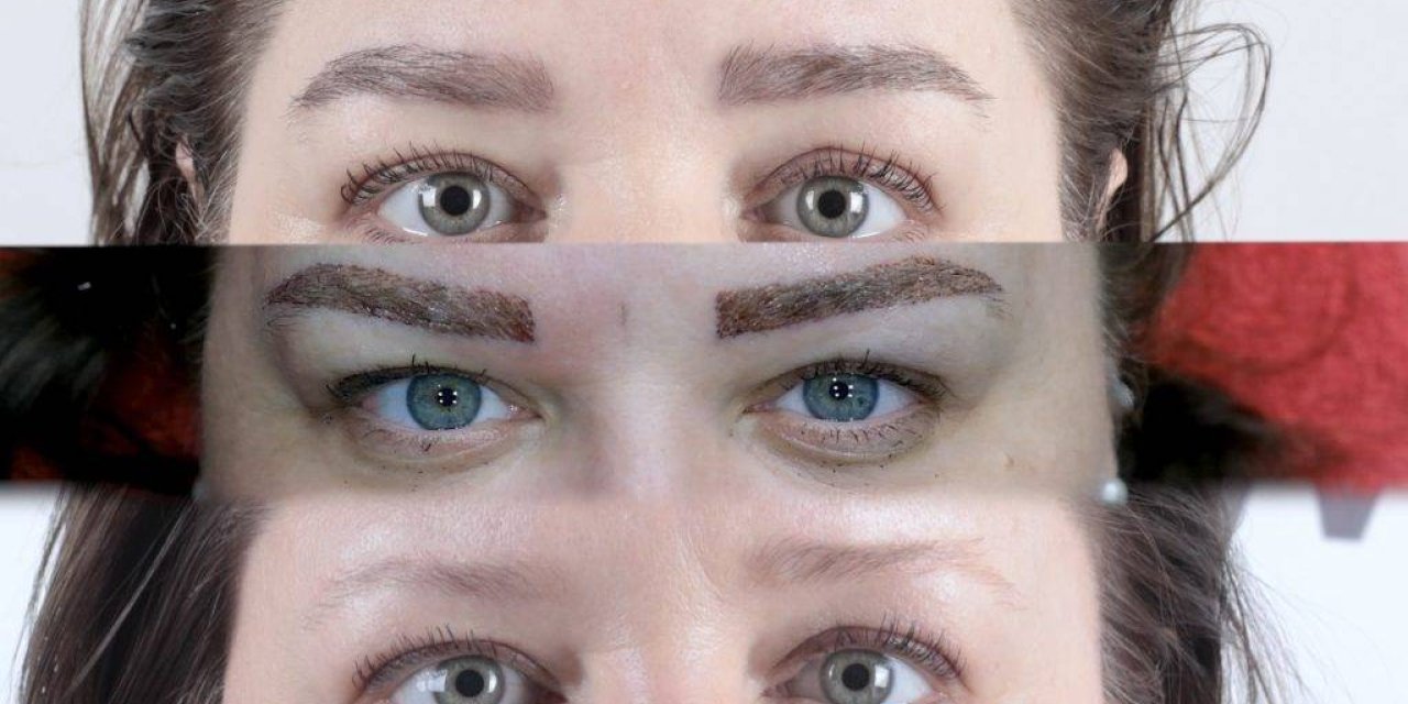 Micro Brow Implant Nedir?
