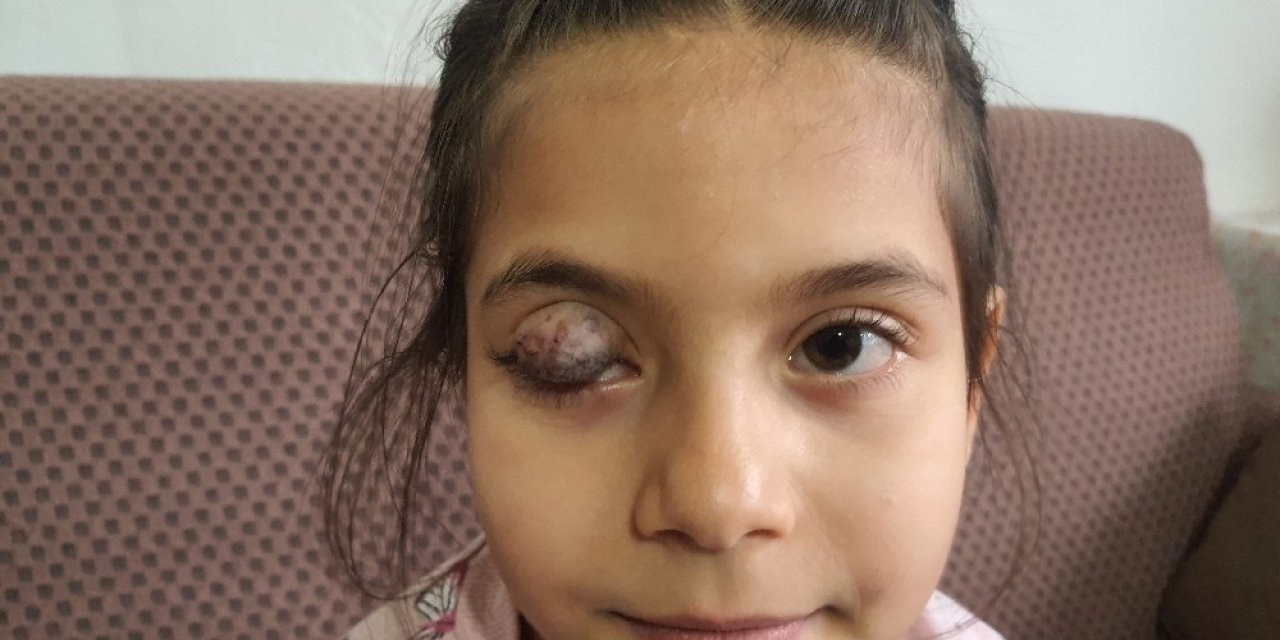 Göz Kapağında Doğuştan Tümör Bulunan 7 Yaşındaki Beyza’nın Yardım Çığlığı