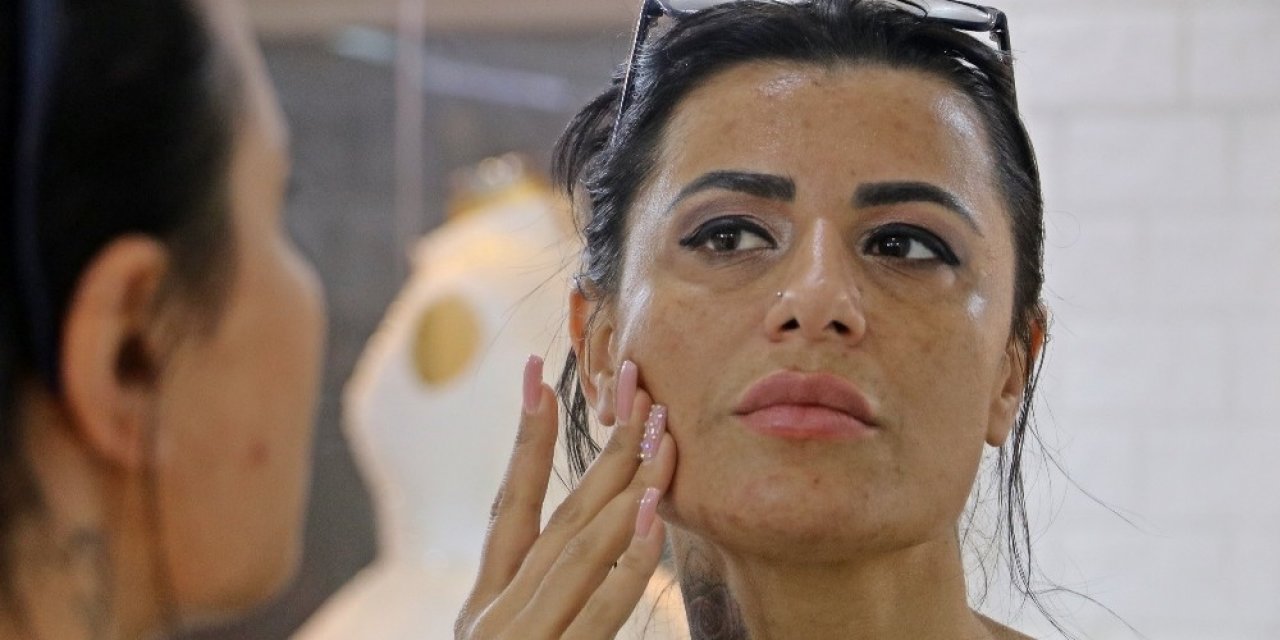 Güzelleşmek İsterken Yüzünde Yanıklar Oluşan Kadın: "gelin Adaylarını Görünce İnsanın Psikolojisi Bozuluyor"