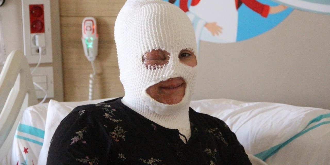 Başından Aşağıya Çaydanlık Dökülen Kadın Feci Şekilde Yandı