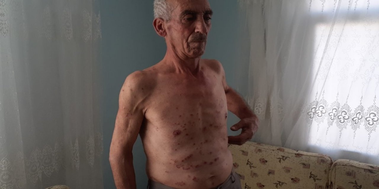 13 Yıldır Kaşınıyor