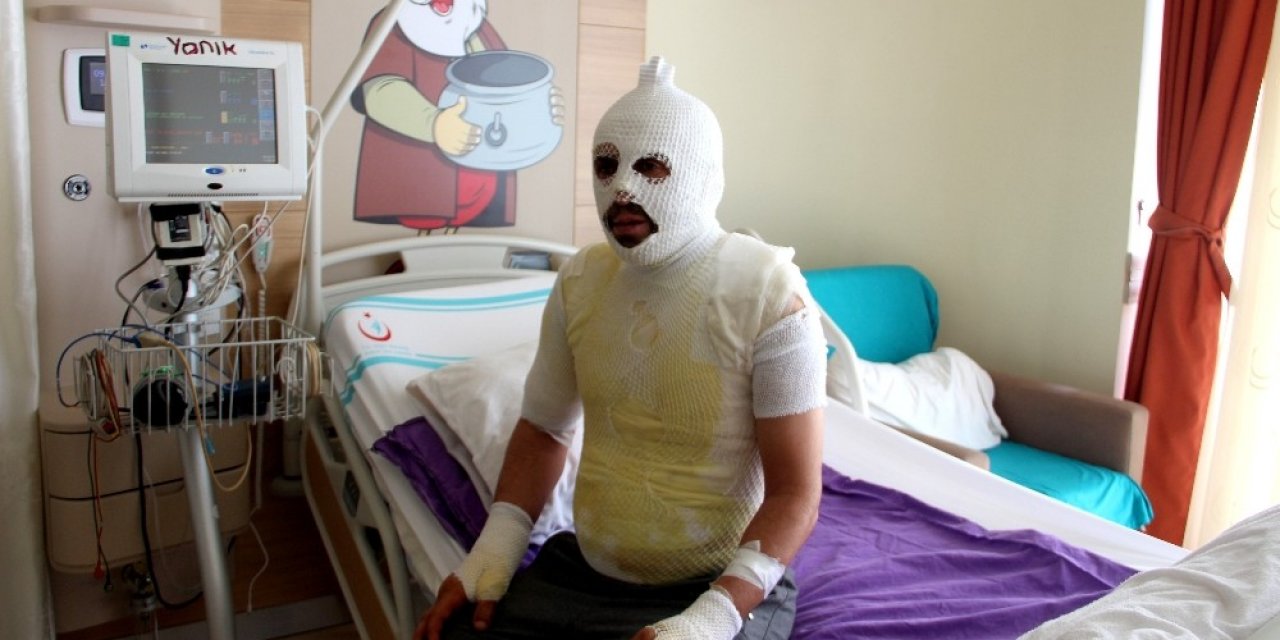 Akrabaları Tarafından Kaynar Suyla Yakıldığını İddia Etti