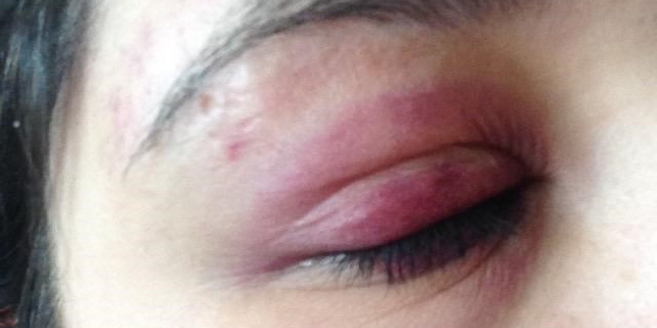 Genç Kızı Darp Eden Avukat: “alkolü Döktüm Diye Şişe Fırlatıp Tokat Attı”