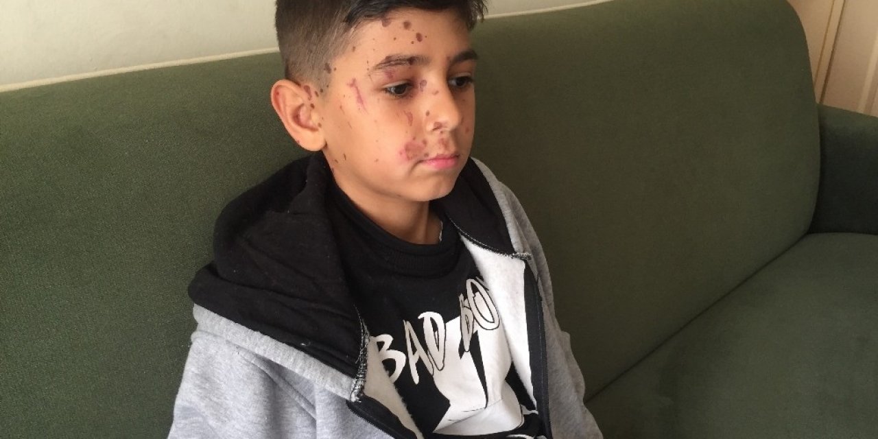 Arkadaşının Attığı Temizlik Maddesi Kör Ediyordu