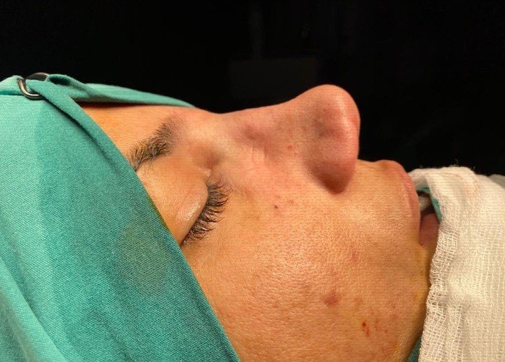 Burun Estetiği Kabusu Oldu