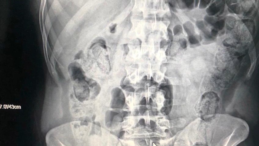 Yolcu Kılığındaki Kuryelerin Midelerinden 871 Gram Uyuşturucu Çıktı