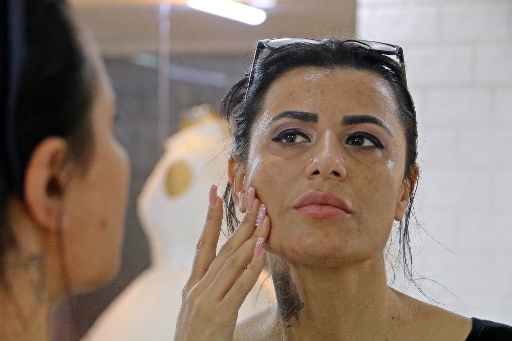 Güzelleşmek İsterken Yüzünde Yanıklar Oluşan Kadın: "gelin Adaylarını Görünce İnsanın Psikolojisi Bozuluyor"