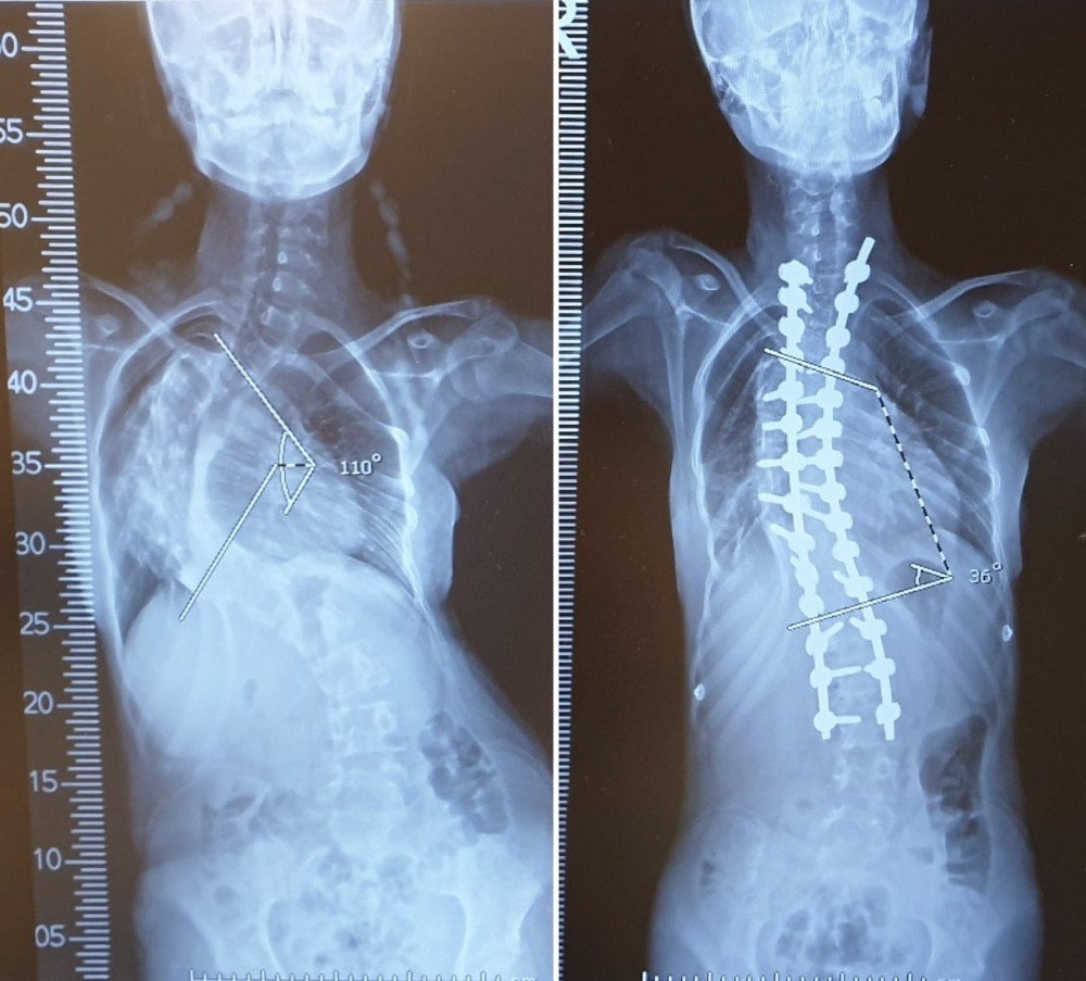 Mersinli Skolyoz Hastası Medine, Ameliyatla Yeniden Doğdu