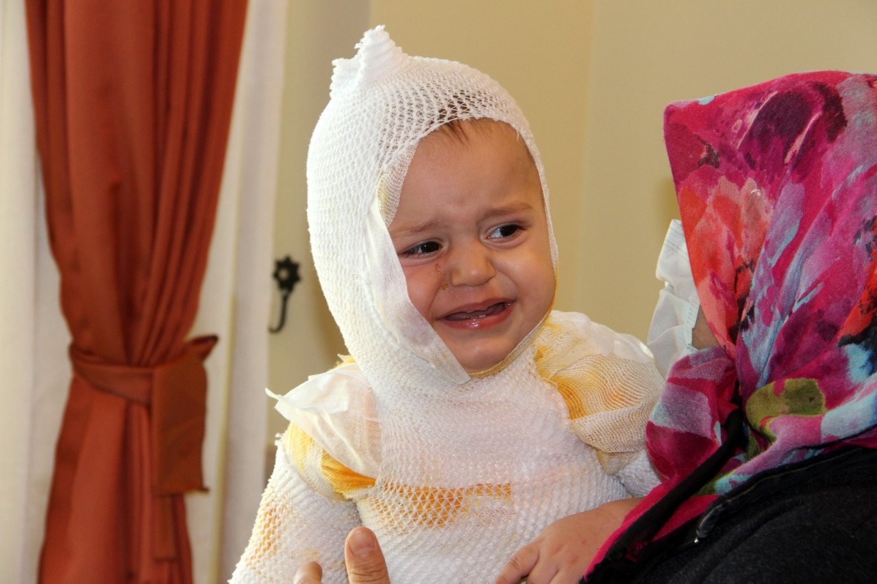 Erzincan’da Üzerine Kaynar Süt Dökülen Çocuk Hastanelik Oldu